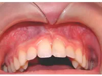 Frenectomy case