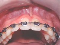 Frenectomy case