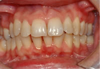 Scaling and Root Planing case
