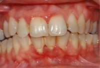 Scaling and Root Planing case