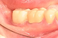 After crown lengthening treatment with crown in place