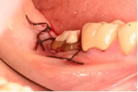 After crown lengthening treatment