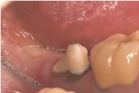 Before treatment for Crown Lengthening
