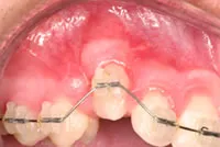 Cuspid Exposure case