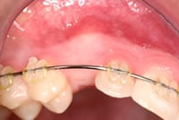 Cuspid Exposure case