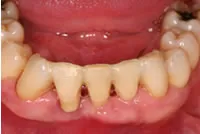 Stabilization of Loose Teeth case - Post-Op