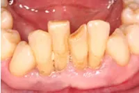 Stabilization of Loose Teeth case - Pre-Op