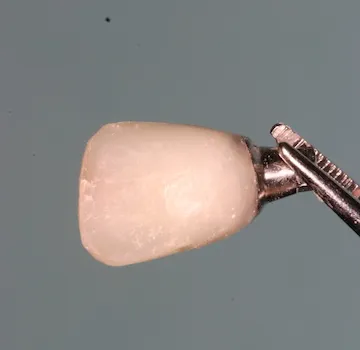 Image of dental implant