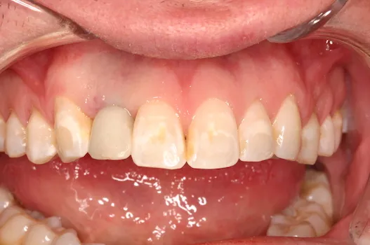 After image of dental implant surgery