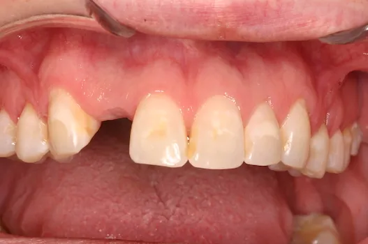 Before image of dental implant surgery