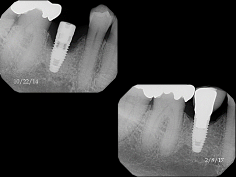 LAPIP X-Ray
