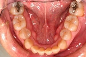 Invisalign Case 1 after image - lower jaw