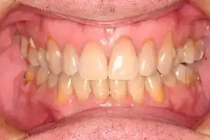 Invisalign Case 1 after image - front view