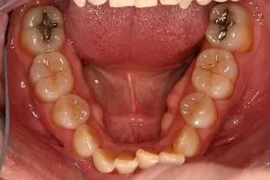 Invisalign Case 1 before image - lower jaw