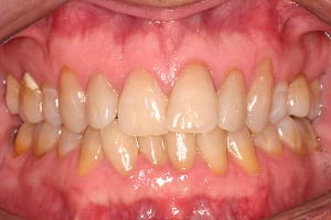Invisalign Case 1 before image - front view