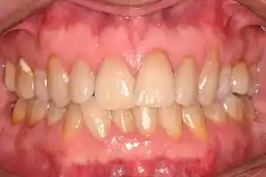 Invisalign Case 1 before image - front view