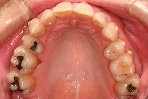 Invisalign Case 1 after image - upper jaw
