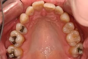 Invisalign Case 1 before image - upper jaw