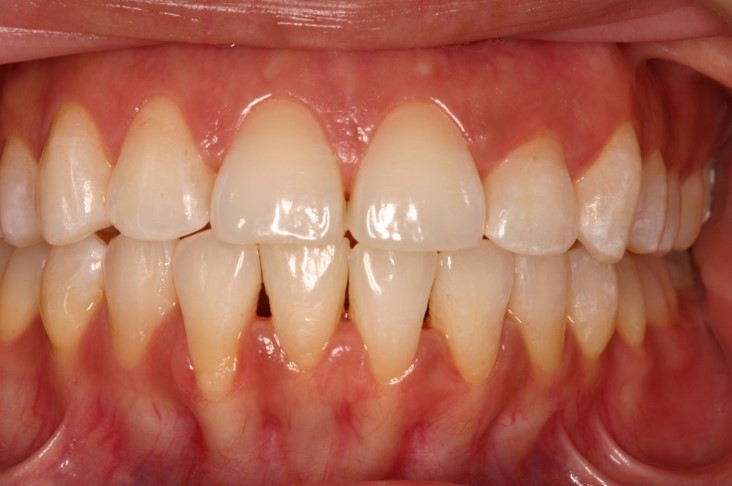 Invisalign Case 2 after image - front view