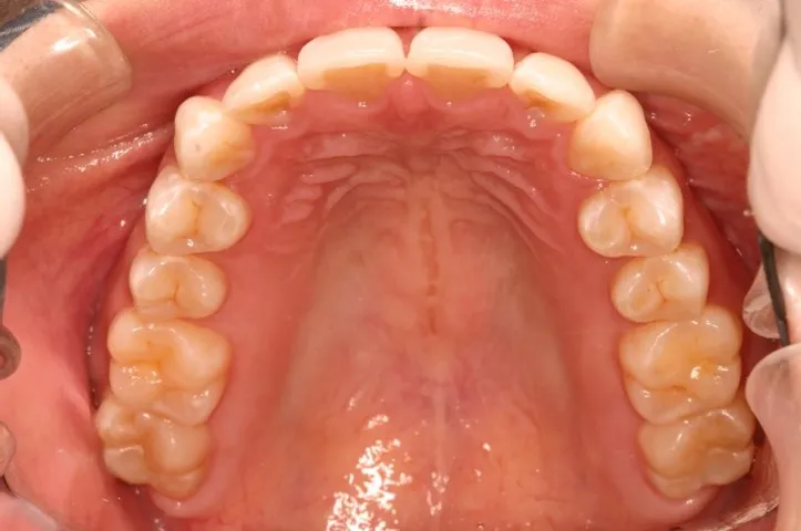 Invisalign Case 2 after image - upper jaw