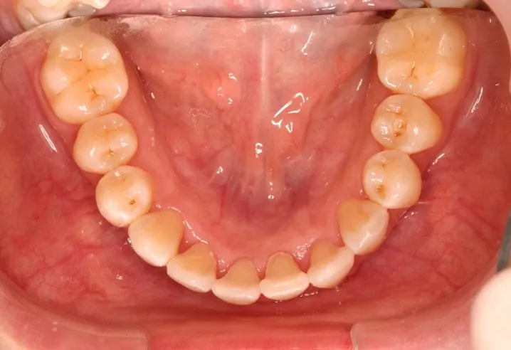 Invisalign Case 2 after image - lower jaw