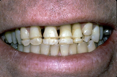 Intracronal stabilization - wire bonding 