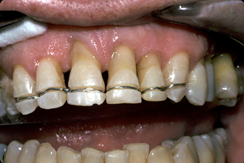 Intracronal stabilization - wire bonding 