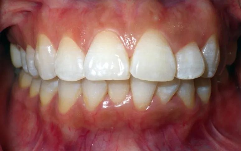 Invisalign Case 2 before image - front view