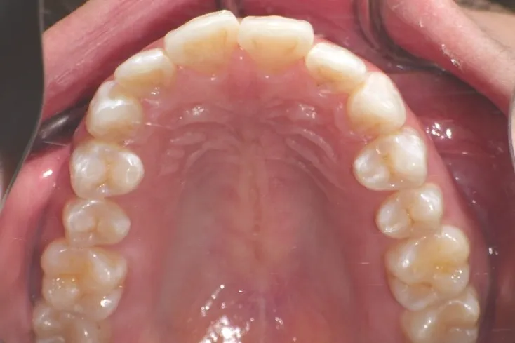 Invisalign Case 2 before image - upper jaw
