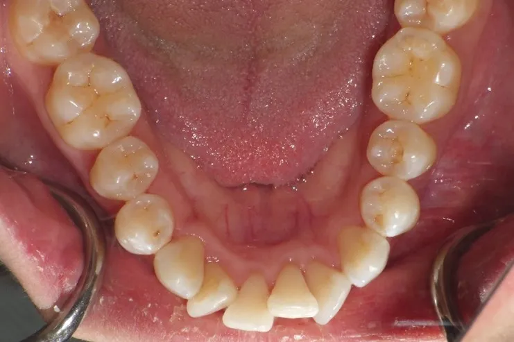 Invisalign Case 2 before image - lower jaw