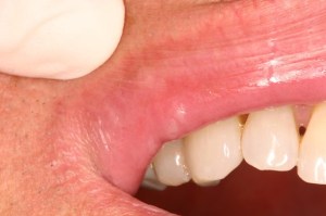 Laser Removal of Hemangioma Case 1 - Lip View After