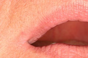 Laser Removal of Hemangioma Case 1 - Close Up View After