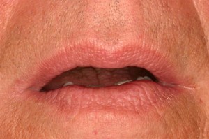 Laser Removal of Hemangioma Case 1 - Front View After