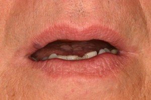 Laser Removal of Hemangioma Case 1 - Front View Before