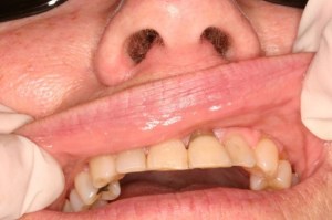 Laser Removal of Hemangioma Case 2 - Lip View After
