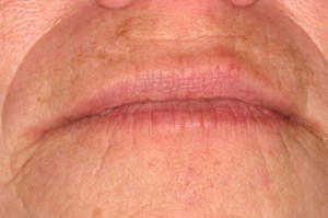 Laser Removal of Hemangioma Case 2 - Front View After