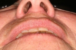 Laser Removal of Hemangioma Case 2 - Below View Before