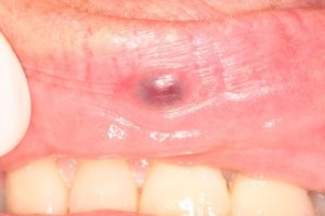 Laser Removal of Hemangioma Case 2 - Lip View Before