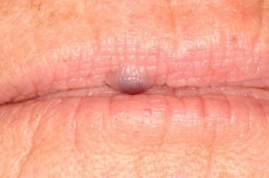Laser Removal of Hemangioma Case 2 - Close Up View Before