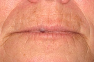 Laser Removal of Hemangioma Case 2 - Front View Before