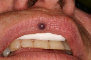 Laser Removal of Hemangioma Case 2 - Below View Before