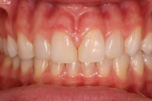 Dental bonding used to close the gap between two front teeth