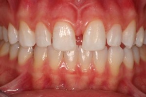Before treatment for dental bonding there was a gap between the front two teeth