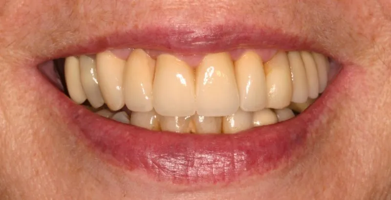 Photo taken after crown and bridge treatment
