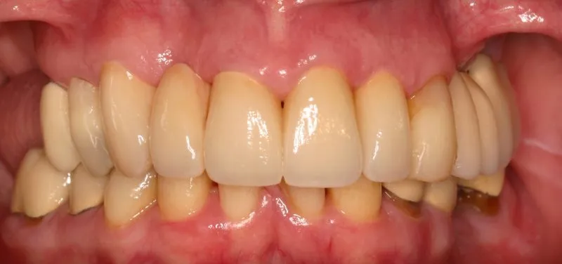 Photo after Dental Crown, Bridge, and Bonding treatments