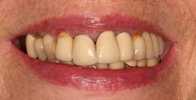 Photo taken before crown and bridge treatment