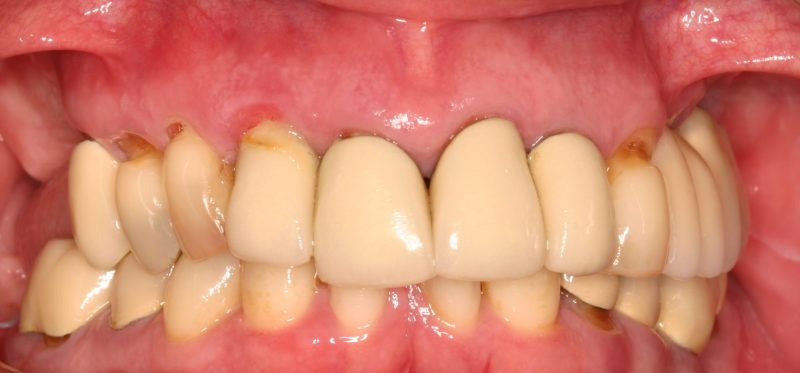 Photo before Dental Crown, Bridge, and Bonding treatments