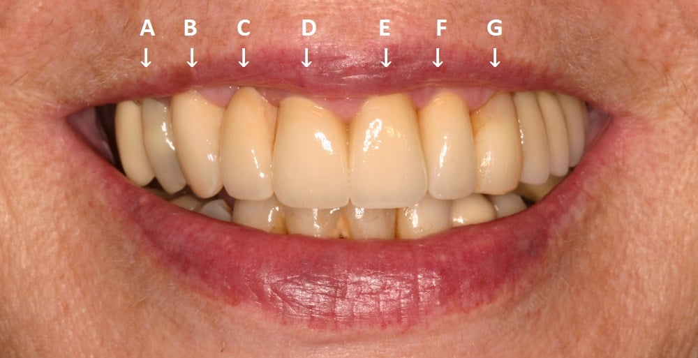 Photo taken after crown and bridge treatment