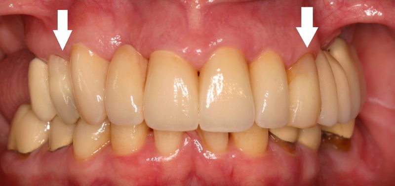 Photo taken after crown and bridge work to fill dental erosion