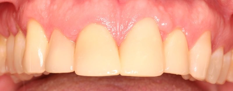 Photo after Tooth Veneers treatment